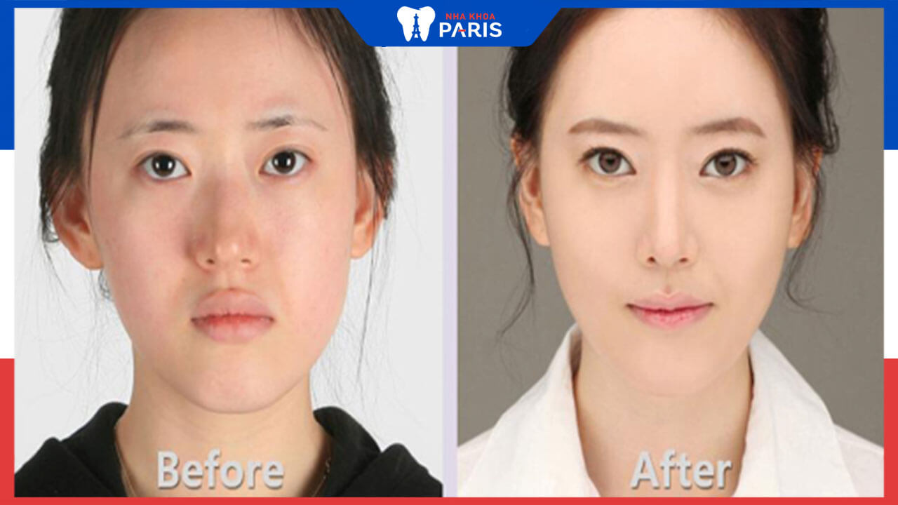 phẫu thuật cho khuôn mặt dài là gì? những ai cần phẫu thuật